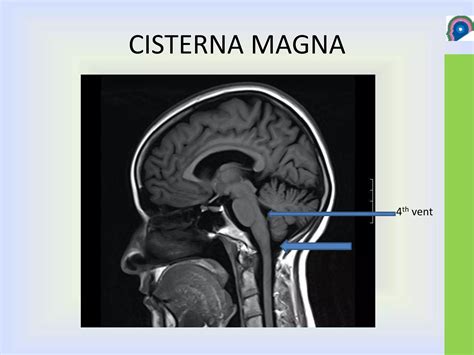 Cisterns of brain | PPTX