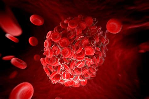 Thrombocythemia: Causes, Symptoms, and Treatment | Healthtian