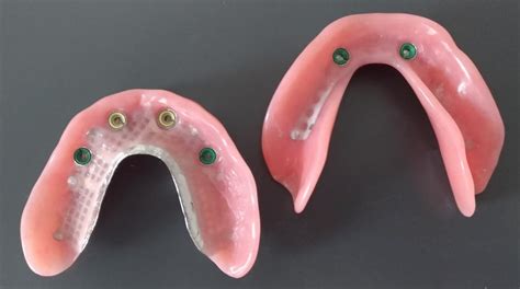 Locator Implant Retained Dentures - Burnham Denture Clinic in Edmonton | Bonnie Doon Denturist ...