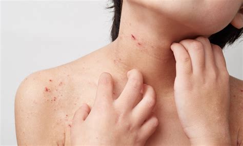 Managing Eczema & Dry Skin During Winter – Bioderma India