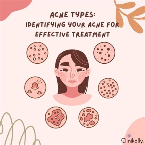 Ultimate Acne Treatments: Overnight & Lasting Solutions | Clinikally