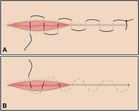 Running Subcuticular Suture