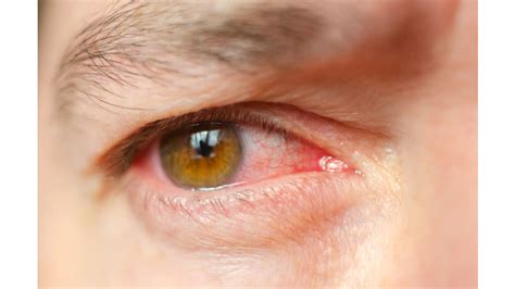 Indore: Probe Panel Fails To Identify Reasons For Infection, No Action ...