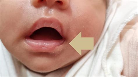 Breastfeeding Baby Has Blister On Lip at Reginald Hopkins blog
