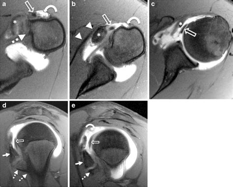 Mr Arthrogram Shoulder 的图像结果
