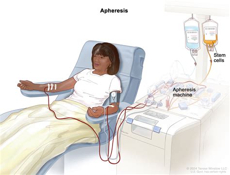 Apheresis Platelets Apheresis Donations PDF | PDF | Blood Donation