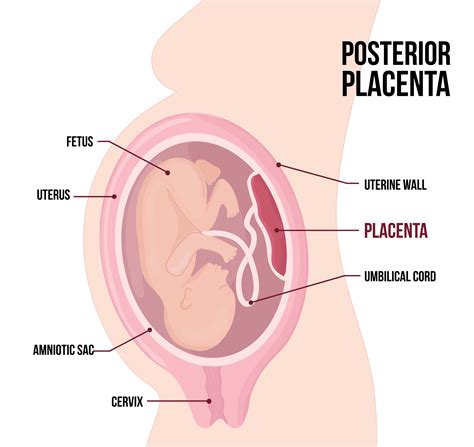 Posiciones de la placenta