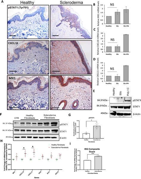 Systemic Sclerosis Dermal Fibroblast Exosomes Trigger Type 1 Interferon Responses in ...