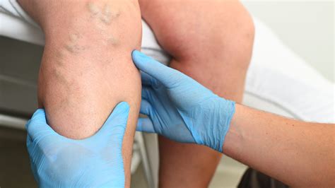 What does a blood clot feel like? Hear from cardiologists.