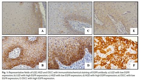 Epidermal Growth Factor Receptor (EGFR) is Overexpressed in Both ...