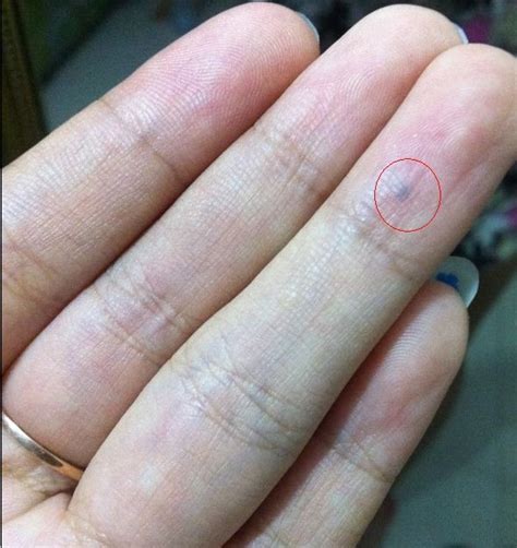 手指头上长了一个黑点,这是什么？有点疼，有图_百度知道