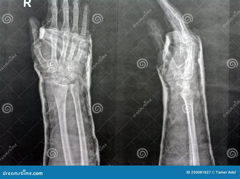 Plain X Ray Right Wrist Joint Shows Right Distal Radius Fracture ...
