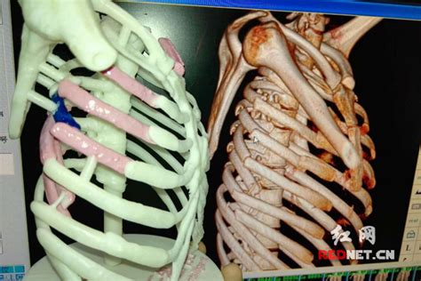 7根肋骨断成数截3D打印复制成功手术 成世界首例|被砸|手术|肋骨_新浪新闻