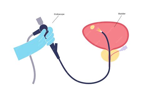 Premium Vector | Cystoscopy is a minimally invasive procedure Examination and treatment of the ...