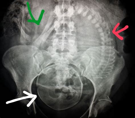 Rib subluxations are they real – Artofit