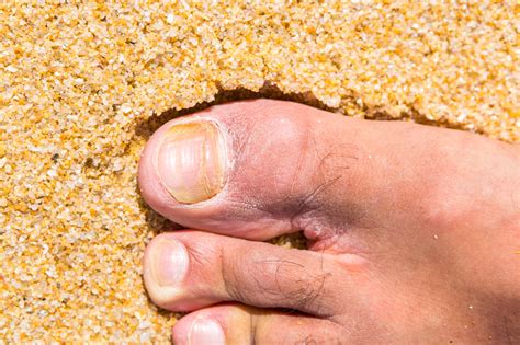 Top 6 Warning Signs of Toenail Fungus - The Foot Doc™