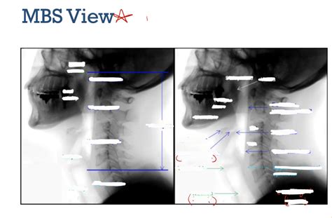 Image result for Modified Barium Swallow Video Example