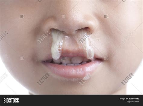 White Mucus In Nose
