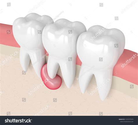 White Cyst On Gum Line