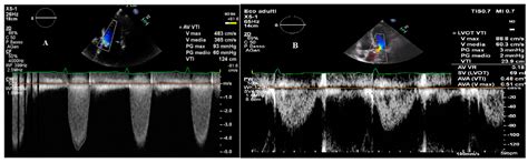 Diagnosis and Management of Aortic Valve Stenosis: The Role of Non-Invasive Imaging
