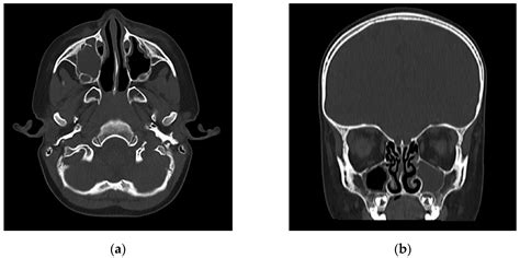 Unilateral Palpebral Edema as Central Sign of Acute Enterobacter ...