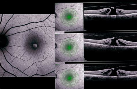 Eye Chart For Macular Hole at Charlie Gladys blog