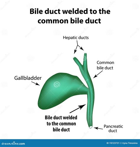 Pathology Of The Gallbladder. The Bend Of The Gallbladder. Set. Vector Illustration ...