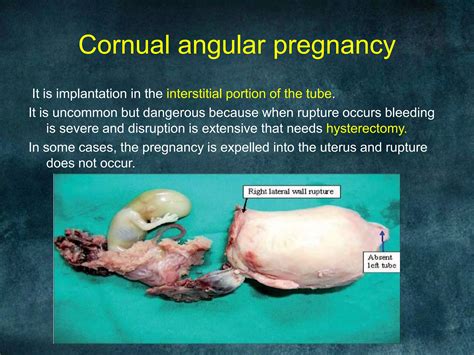 Ectopic pregnancy | PPTX