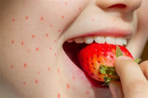 Casos de arqueros destacados que enfrentan alergias alimentarias
