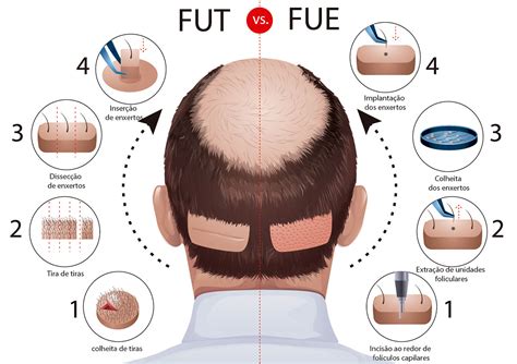 How To Get Rid of Scars after FUE or FUT Hair Transplant