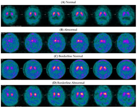 Optimal DaTQUANT Thresholds for Diagnostic Accuracy of Dementia with Lewy Bodies (DLB) and ...