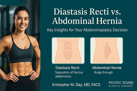 Understanding Diastasis Recti vs. Abdominal Hernia: Key Insights for Your Abdominoplasty ...