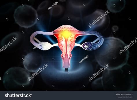 Female Reproductive System Diseases Uterus Cancer Stock Illustration 2251358873 | Shutterstock