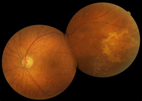 Image result for Problem Blob Eye