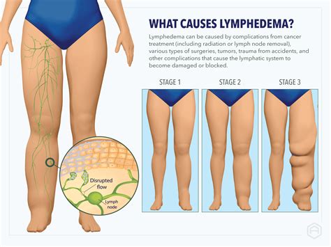 What Are The Warning Signs Of Lymphedema at Finn Daintree blog