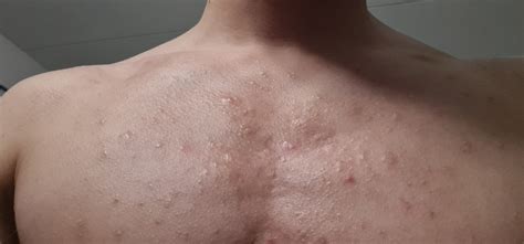 light white bump on chest and shoulder, Steatocystoma Multiplex - Back ...