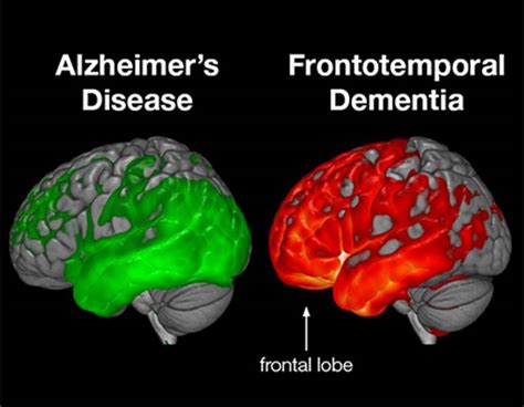 Frontotemporal Dementias - Practical Neurology