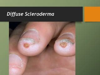 Image result for Diffuse Scleroderma