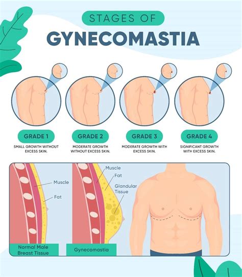 Gynecomastia: What It Is, What Causes It, And How to Prevent It - Alto BioHacks