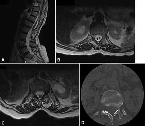 Tethered spinal cord syndrome in adults in the MRI era: recognition ...