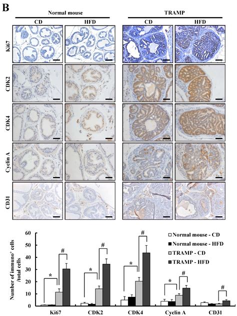A High-Fat Diet Containing Lard Accelerates Prostate Cancer Progression ...
