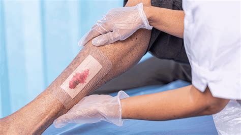 How to look after your wound