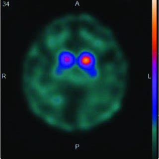 Image result for Normal DaTscan