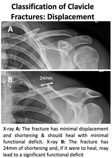 Clavicle Fracture