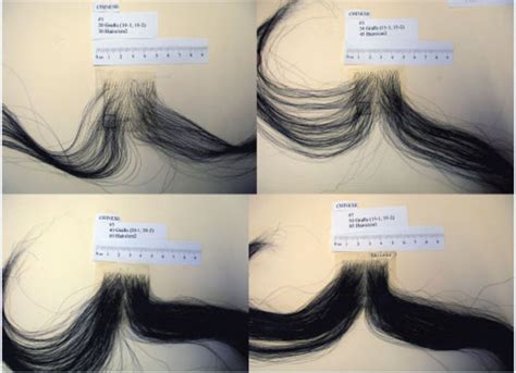 Normal Hair Density 的图像结果