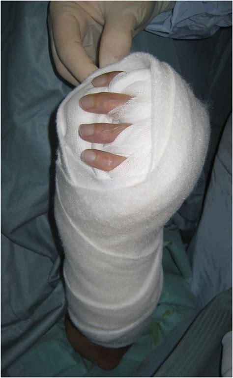 Image result for Hand Dysfunction