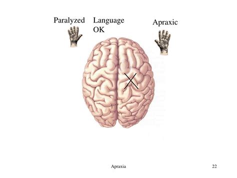Image result for Apraxia Example