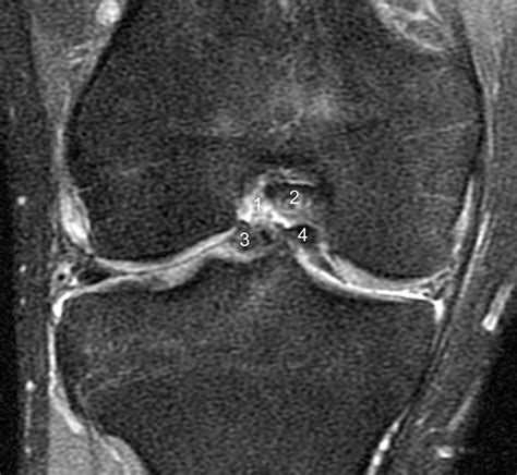 Bucket-handle Tear of the Meniscus - Radsource