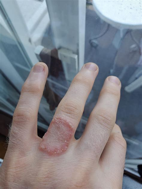 Ring shaped raised skin and pimples on finger : r/DermatologyQuestions