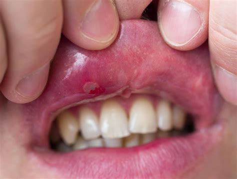 Kuvatulokset haulle blister on inner lip of mouth